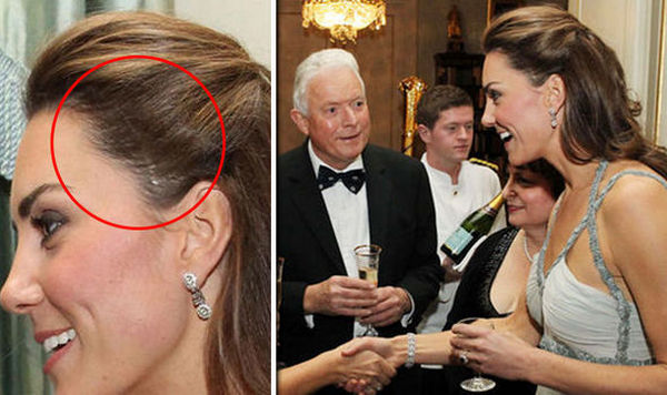 СМИ обеспокоены огромным шрамом на голове у Кейт Миддлтон (ФОТО)