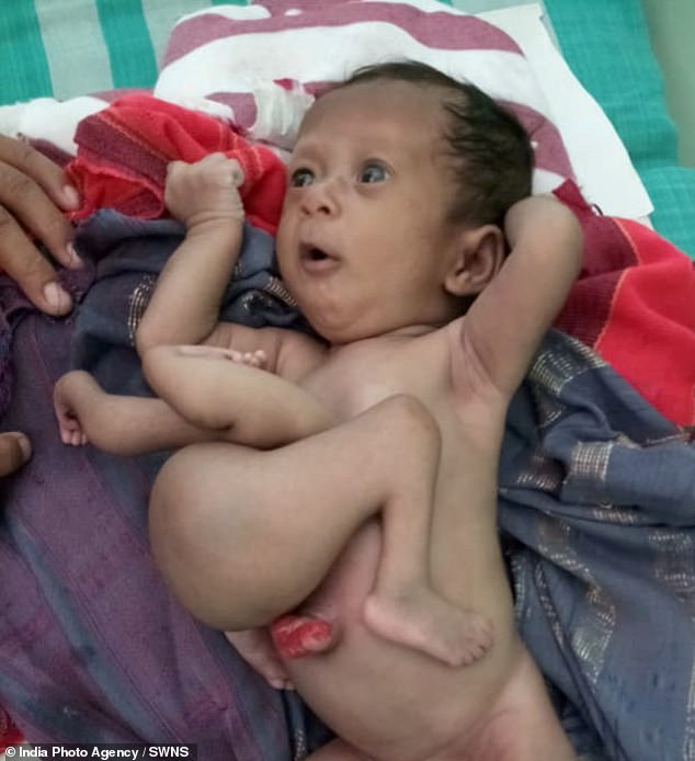 В Индии родилась девочка с руками и ногами близнеца-паразита на животе (ФОТО)