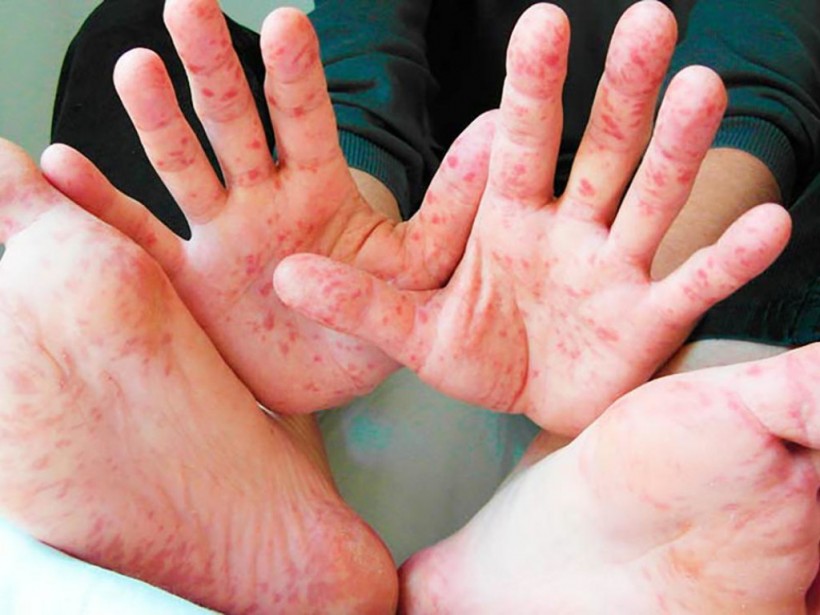 За год заболеваемость корью в Украине выросла в 17 раз – Минздрав За год заболеваемость корью в Украине выросла в 17 раз – Минздрав