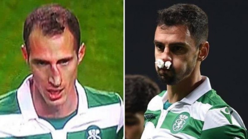 В финале Португальской лиги игрок вышел на замену сломавшего нос партнера и сам сломал нос (фото)