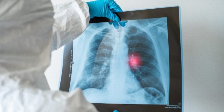 Восстановление легких после коронавируса