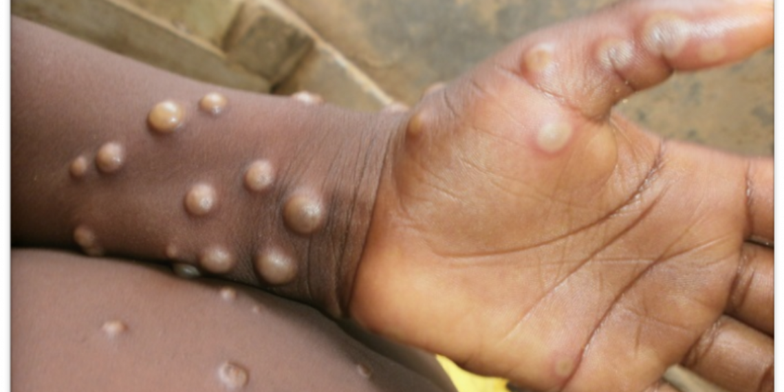 Станет ли обезьянья оспа новым Covid-19: эксперт поделился прогнозом