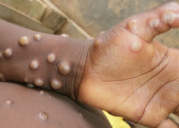 Станет ли обезьянья оспа новым Covid-19: эксперт поделился прогнозом