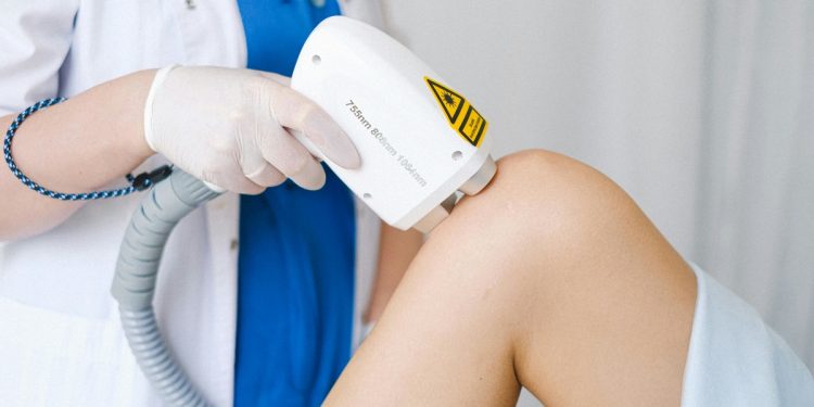 Лазерна епіляція